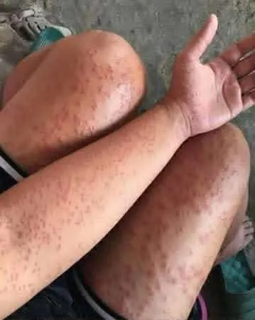 Illustration showing a cluster of red bed bug bites on skin