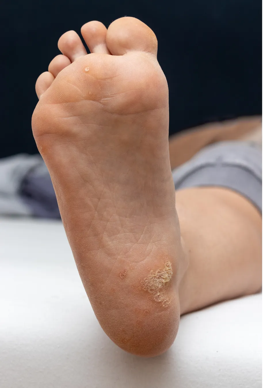 Conceptual illustration of a magnifying glass examining the skin texture on a foot